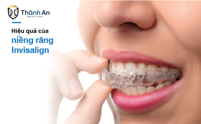 Niềng Răng Invisalign Mất Bao Lâu