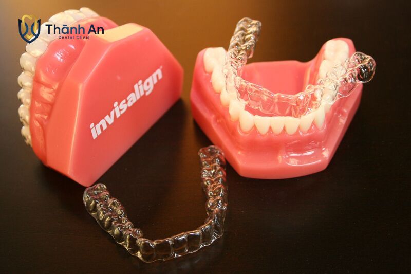 Niềng Răng Invisalign Mất Bao Lâu