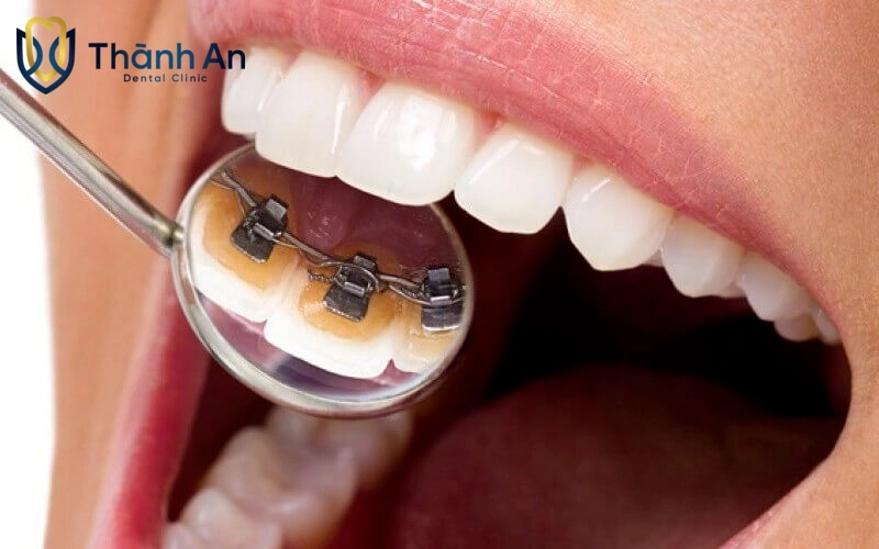 niềng răng mắc cài mặt trong