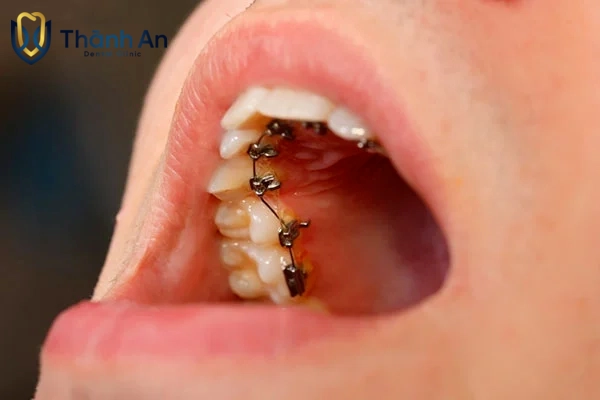 niềng răng mặt lưỡi