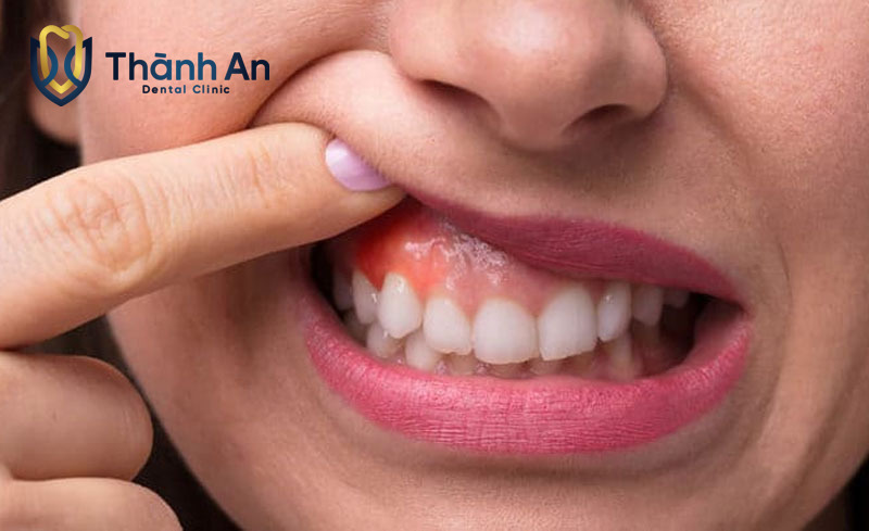 Răng Sâu Lồi Thịt Nguyên Nhân