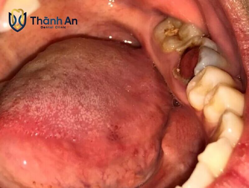 Răng Sâu Lồi Thịt