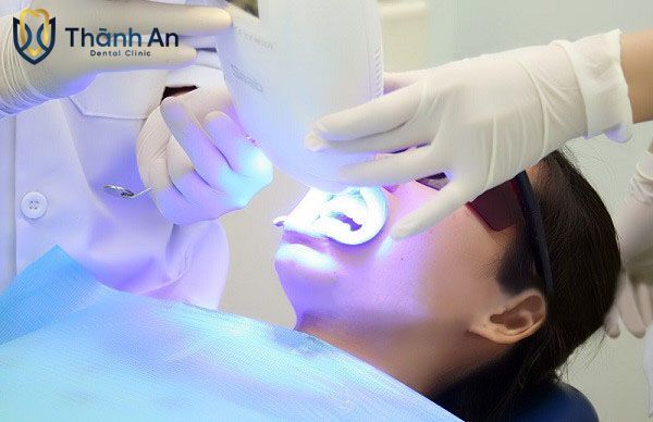 tẩy trắng răng giá bao nhiêu tiền