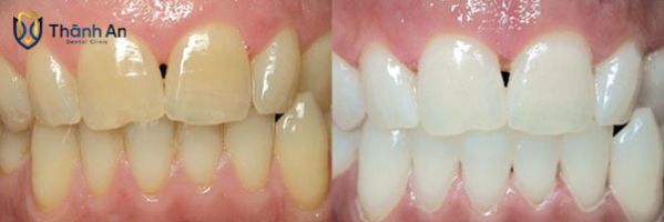 tẩy trắng răng giá bao nhiêu tiền