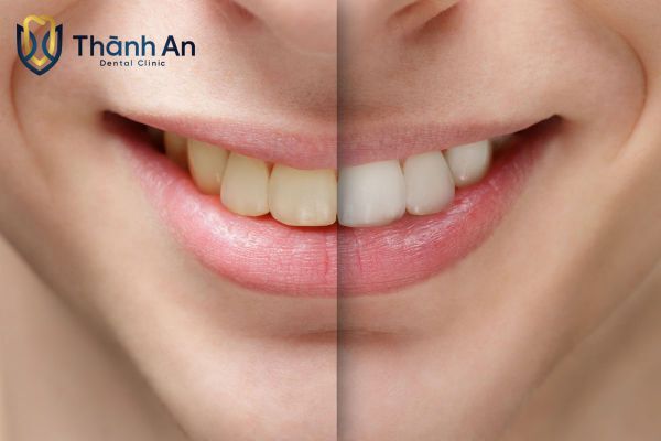 tẩy trắng răng giá bao nhiêu tiền