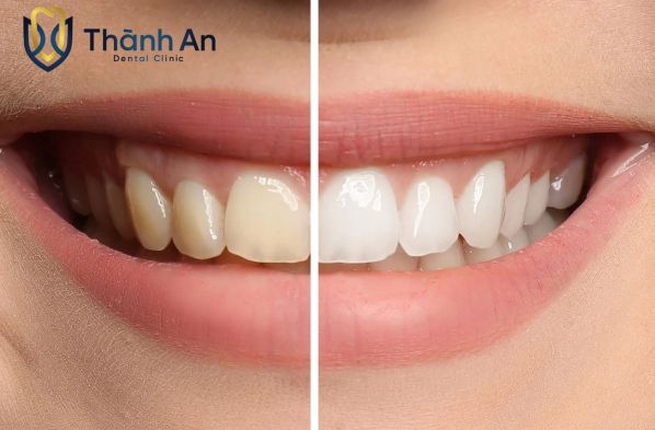 tẩy trắng răng giá bao nhiêu tiền