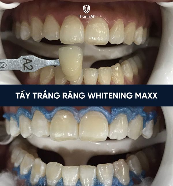 tẩy trắng răng