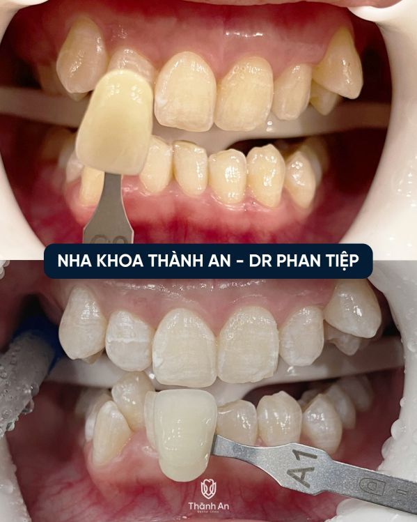 tẩy trắng răng