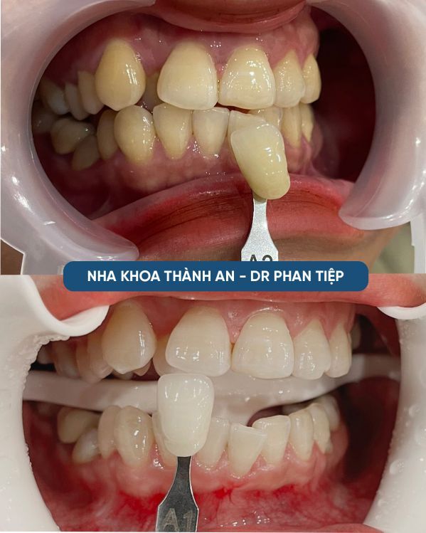 tẩy trắng răng