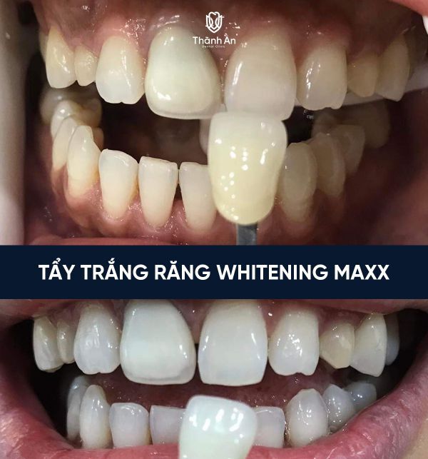 tẩy trắng răng